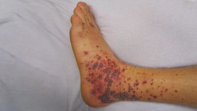 Red Spots On Top Of Foot