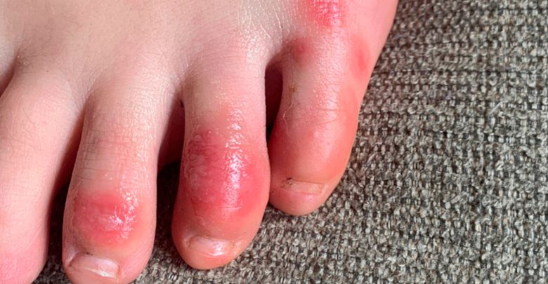 Red Bumps on Top of Foot